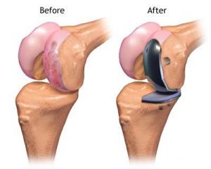 partial-knee-replacement