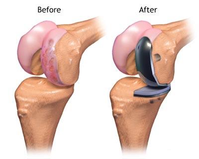 partial-knee-replacement